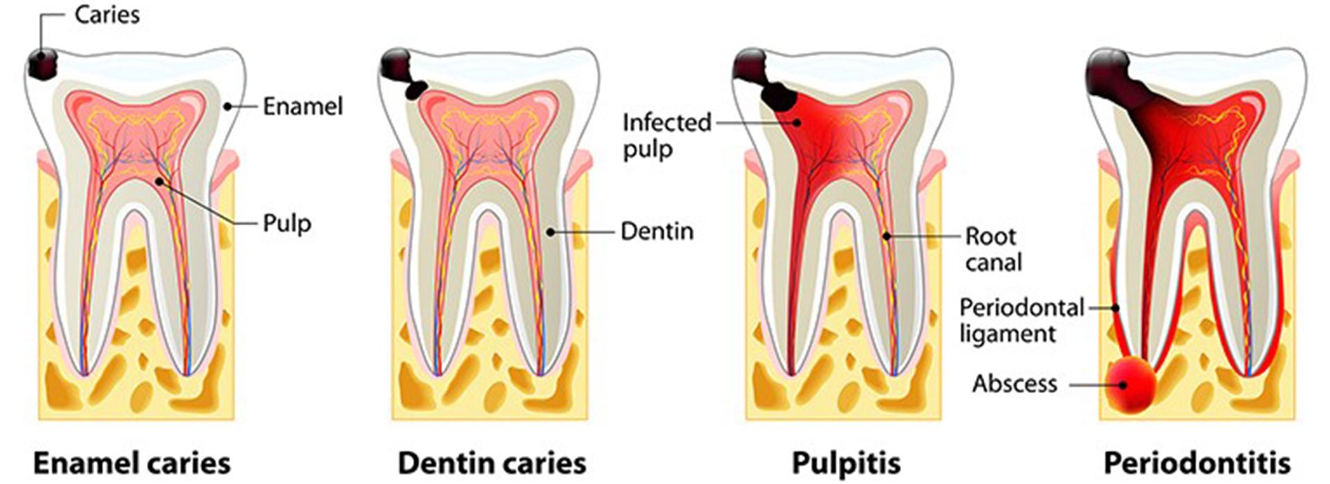 Сколько ходят с лекарством в зубе. Кариес эмали дентина и цемента. Этапы пульпита периодонтит.